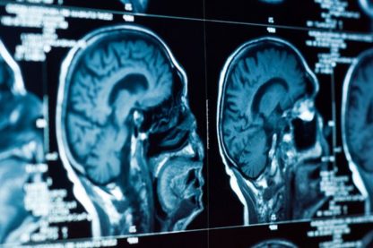 cerveau étude depression