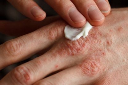 eczema lotion crème filaggrine dermatite atopique proteine gene