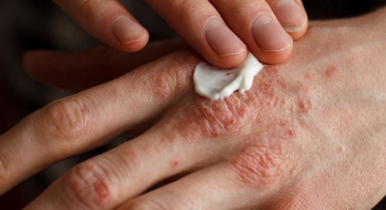 eczema lotion crème filaggrine dermatite atopique proteine gene