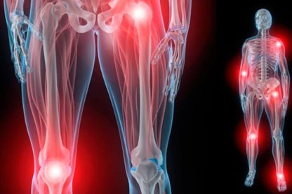 arthrite, génétique, évolution, migration