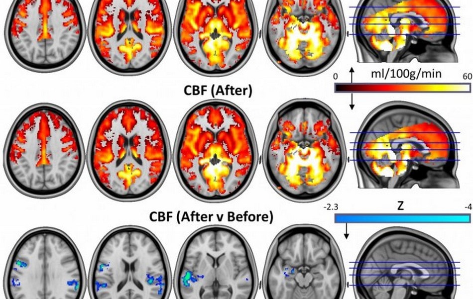 Les champignons hallucinogènes pourraient « réinitialiser » certains