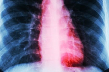 coeur brisé syndrome clinique cardiaque