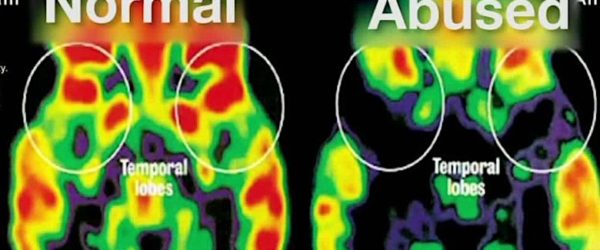 cerveau traumatisme comparaison pet scan
