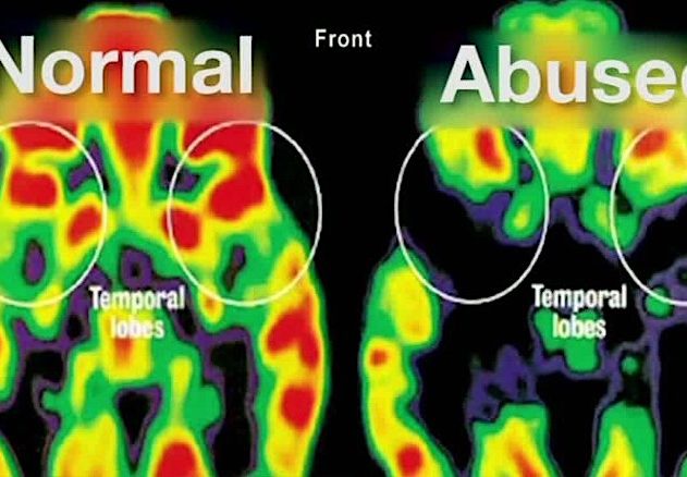 cerveau traumatisme comparaison pet scan