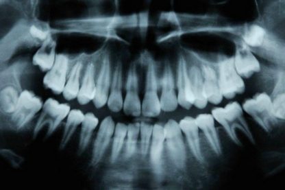 dents irm caries cavité naturel traitement