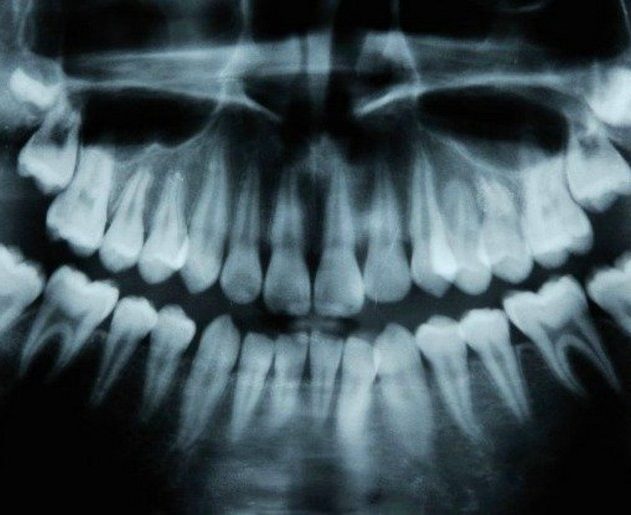 dents irm caries cavité naturel traitement