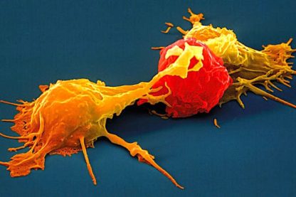cellules tueuses naturelles-traitement cancer