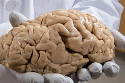 cerveau anatomie autisme trouble neurologique neurologie schizophrenie bipolaire