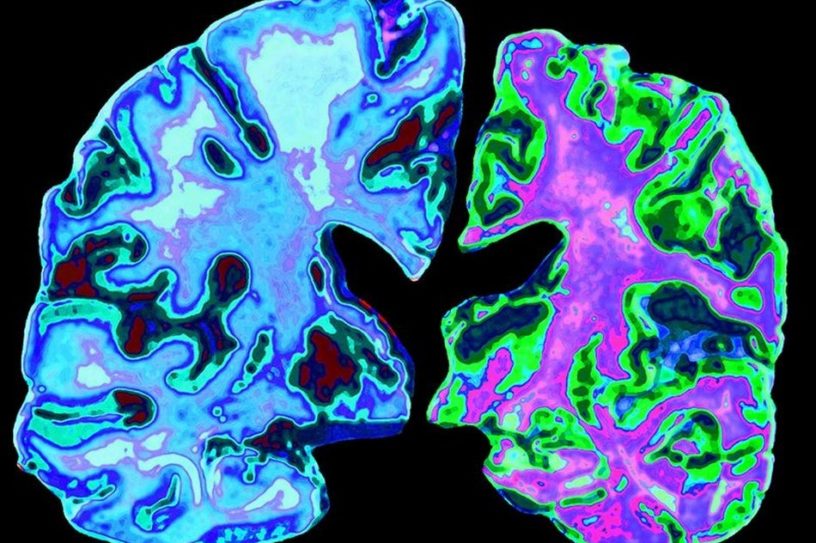 cerveau maladie alzheimer neurodegenerative cellules proteine tau beta amyloide