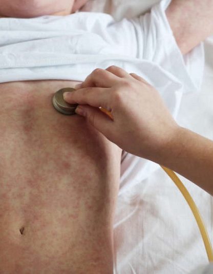 rougeole enfant touristes francais costa rica maladie introduction vaccin vaccination virus