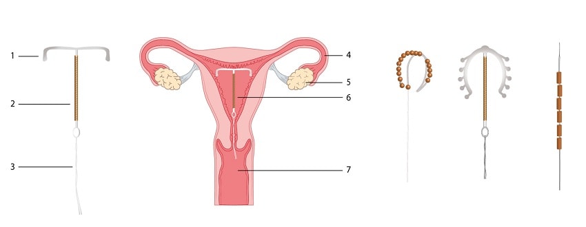 dispositif intra uterin