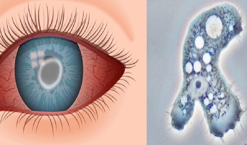 lentilles contact cecite