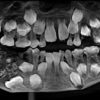 radiographie 500 dents enfant indien