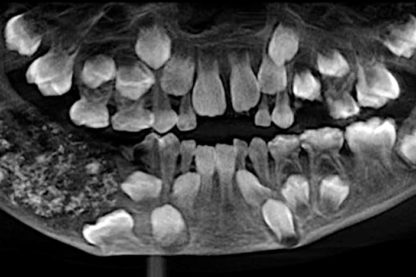 radiographie 500 dents enfant indien