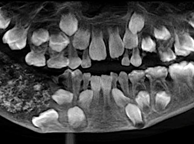 radiographie 500 dents enfant indien