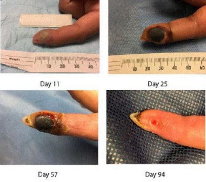doigt femme accident virus variole vaccine laboratoire