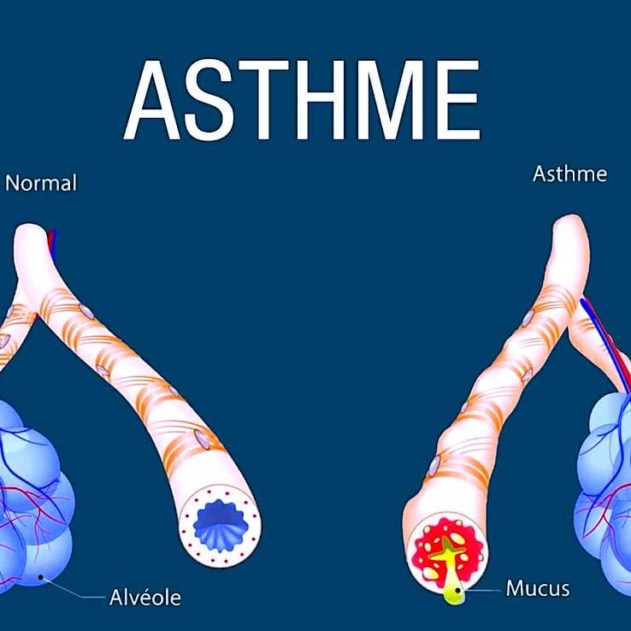 identification facteurs provoquant asthme