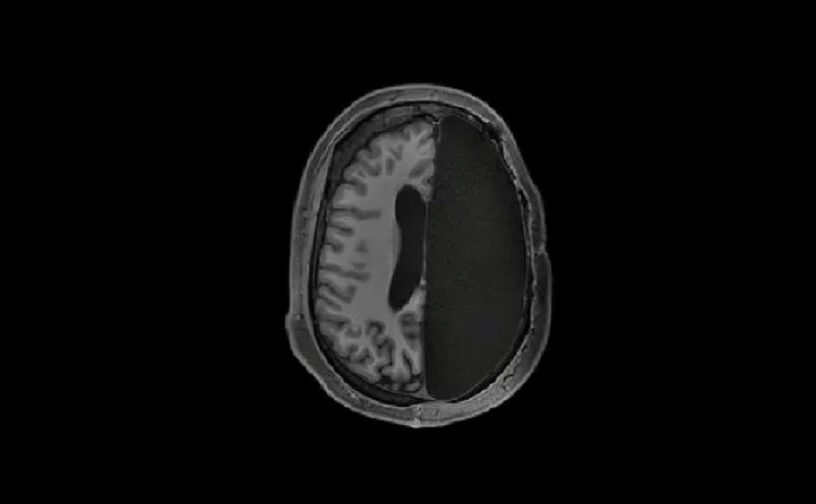 hemisphere cerveau