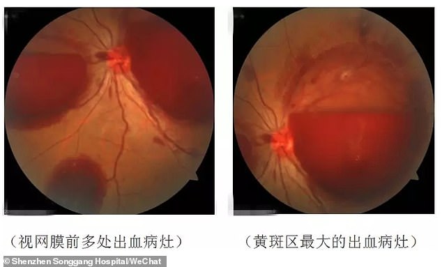 homme chinois aveugle smartphone hemorragie retine