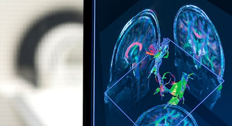 IRM 7 Tesla nouvelles perspectives sclérose en plaques