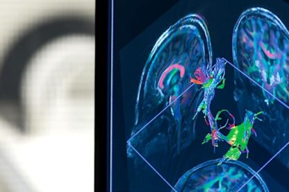 IRM 7 Tesla nouvelles perspectives sclérose en plaques