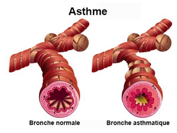 asthme inhalation siARN