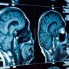 depression cerveau
