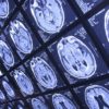 coronavirus cerveau covid19 neurologie