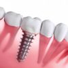implant dentaire