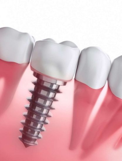 implant dentaire
