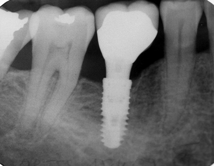 molaire implant dentaire dentition implant