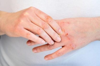 eczéma mains dermatite atopique