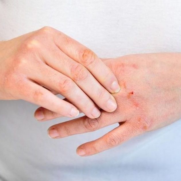 eczéma mains dermatite atopique