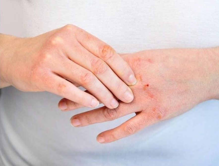 eczéma mains dermatite atopique