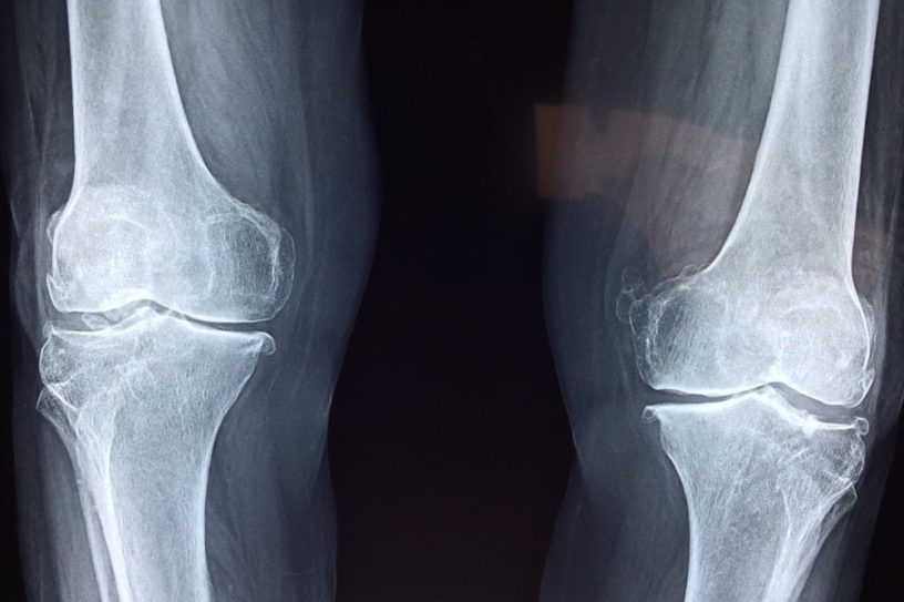 hydrogel remplacement cartilage genoux
