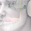 acouphenes traitement musique stimulations langue lenire