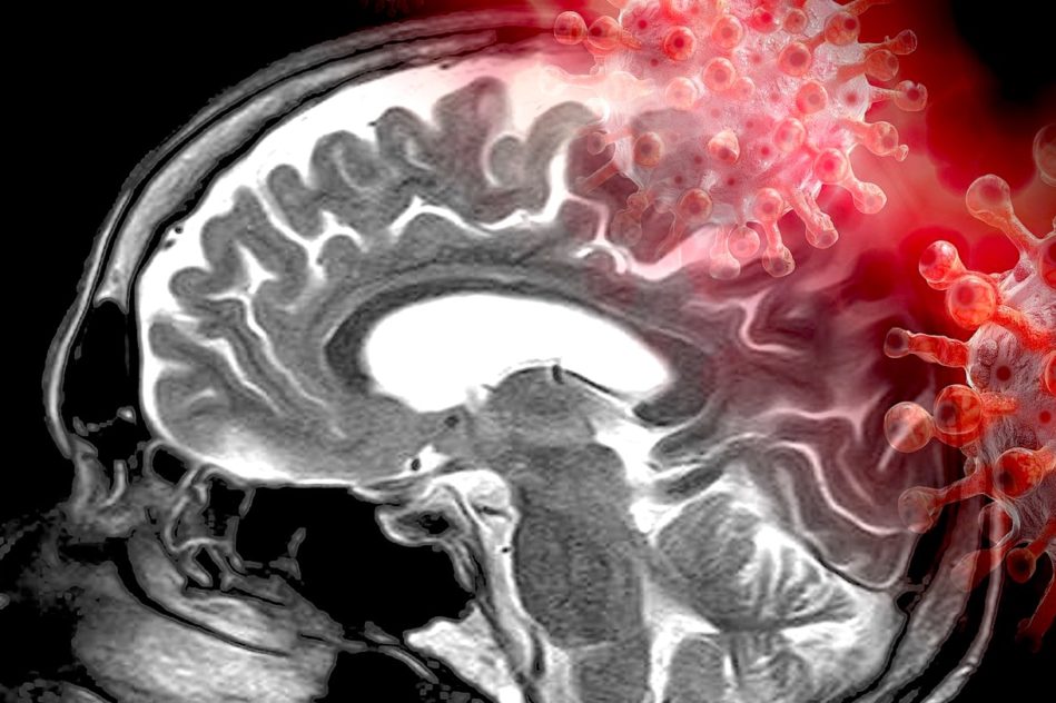 coronavirus cerveau detection anomalies post-covid