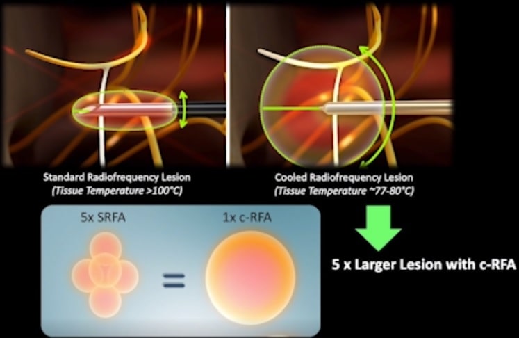 comparaison taille lesions techniques ablation radiofrequence