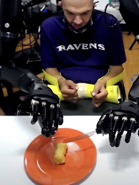 patient quadriplegique se nourrit avec bras prothetiques connectes cerveau