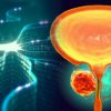 diagnostiquer cancer precision test urine intelligence artificielle