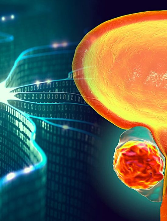 diagnostiquer cancer precision test urine intelligence artificielle