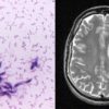 mise evidence lien parasite rapandu cancer cerabral humain