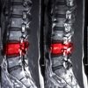 reparer moelle epiniere blessee avec cellules souches-patients
