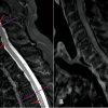 mise evidence lien covid pathologie neurologique rare