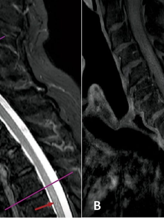 mise evidence lien covid pathologie neurologique rare