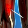 nouvel hydrogel reduit moitie temps recuperation blessures musculaires