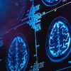 canada medecins enquetent mysterieuse maladie neurologique couv