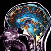 modifications cerebrales provoquees par covid impact sur conscience cognition