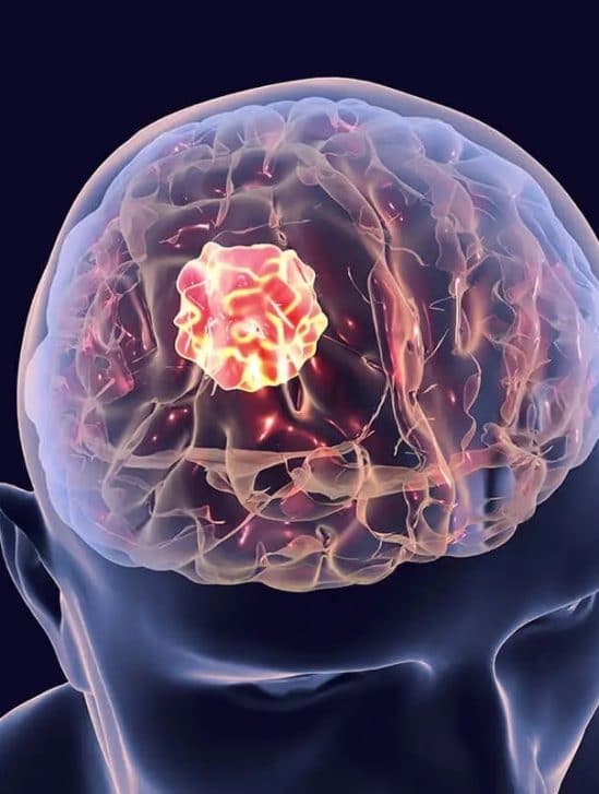structures cancers cerebraux peuvent aider combattre tumeurs