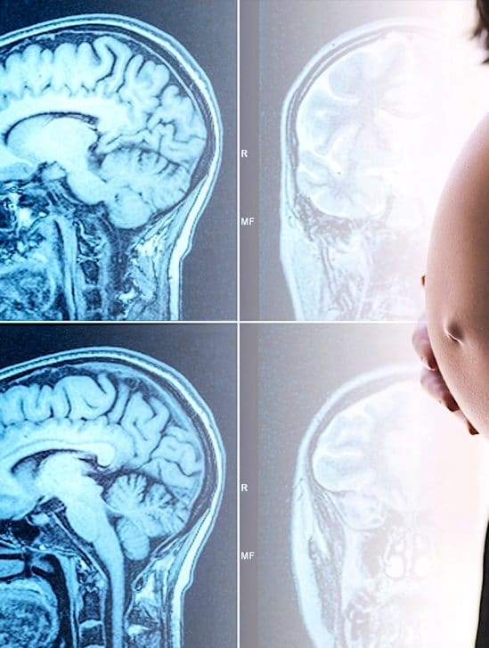 chances tomber enceinte reduites 2 ans apres commotion cerebrale